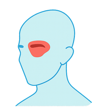 Cluster Headaches